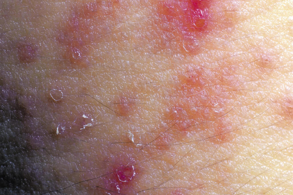 What is Eczema banner